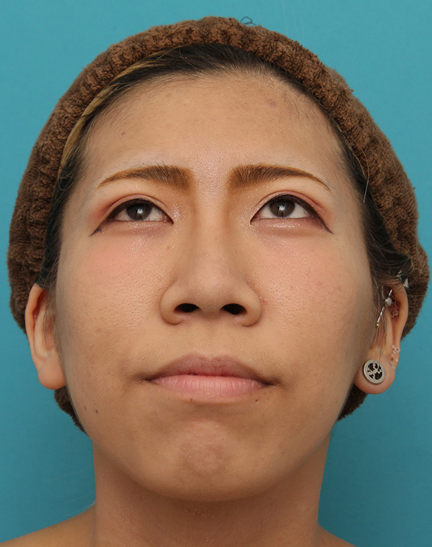 鼻尖形成(鼻尖縮小・だんご鼻修正),20代女性の、総合的なお鼻のお悩みを手術で改善した症例写真,After(6ヶ月後メイクあり),