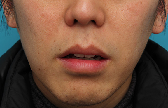 唇を薄く(口唇縮小術),上下の唇を薄くする手術の症例写真,After(1ヶ月後),ba_usuku011_b02.jpg
