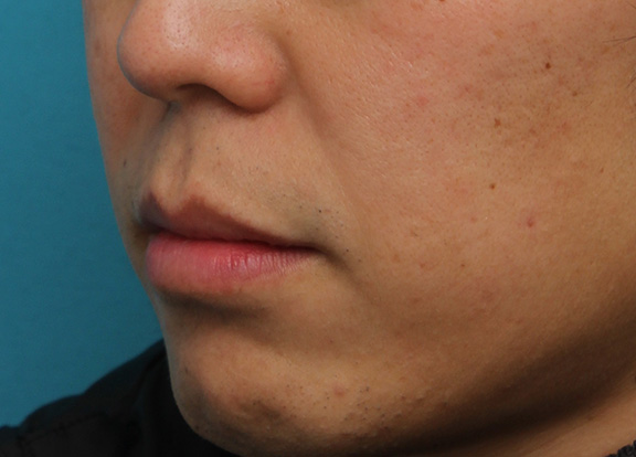 唇を薄く(口唇縮小術),上下の唇を薄くする手術の症例写真,After(1ヶ月後),ba_usuku011_b03.jpg