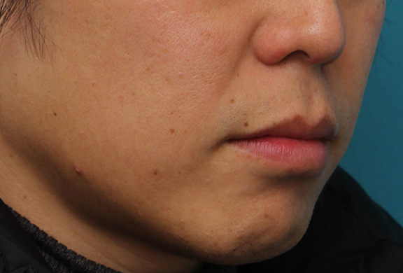 唇を薄く(口唇縮小術),上下の唇を薄くする手術の症例写真,After(1ヶ月後),ba_usuku011_b04.jpg