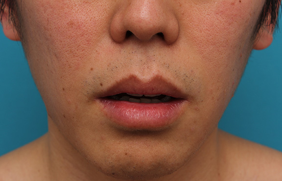 唇を薄く(口唇縮小術),上下の唇を薄くする手術の症例写真,Before,ba_usuku011_b02.jpg