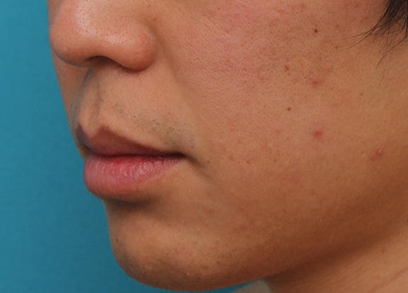 唇を薄く(口唇縮小術),上下の唇を薄くする手術の症例写真,Before,ba_usuku011_b03.jpg
