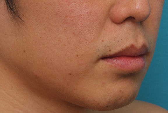唇を薄く(口唇縮小術),上下の唇を薄くする手術の症例写真,Before,ba_usuku011_b04.jpg