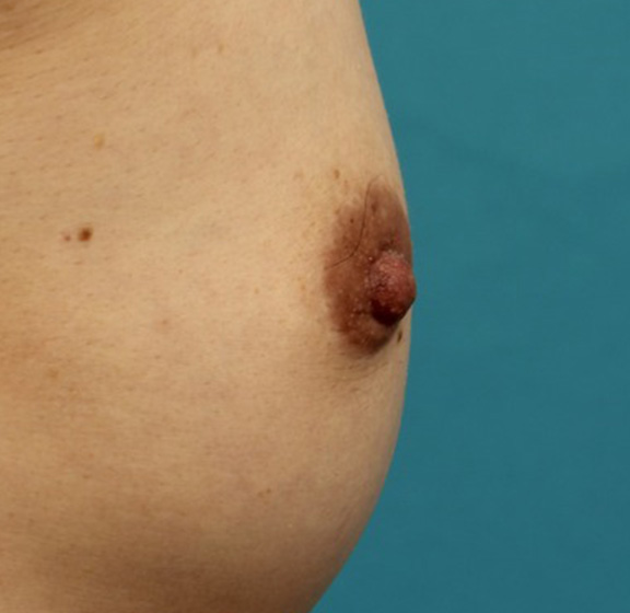 症例写真,40代女性の、授乳によって伸びて垂れ下がってしまった乳頭を縮小した症例写真,After(6ヶ月後),ba_nyuto019_b04.jpg