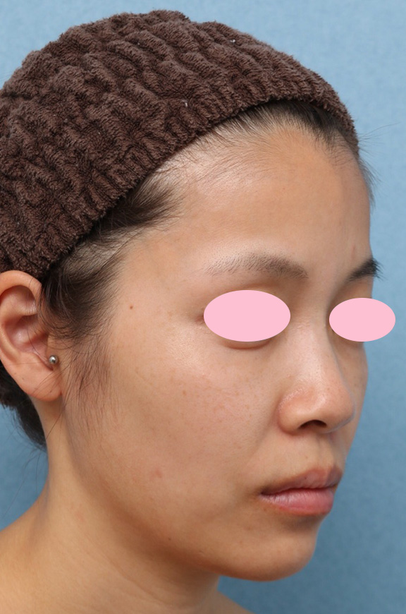 症例写真,トリニティプラスの症例写真,After(3回照射1ヶ月後),ba_eplus004_b02.jpg