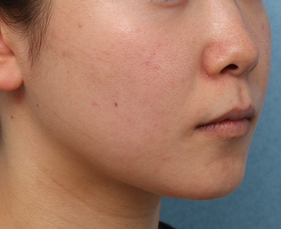 症例写真,メソシェイプフェイスの症例写真,After(3ヶ月後),ba_meso_face013_b02.jpg
