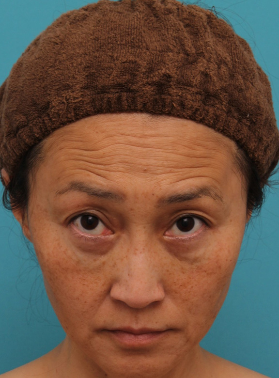目の下の脂肪取り,40代女性の目の下をスッキリさせた症例写真,After(6ヶ月後),ba_shibo_under013_b02.jpg