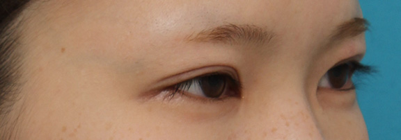 症例写真,全切開法にて二重の幅を自然に広げた症例写真,After(4ヶ月後),ba_sekkai066_b02.jpg