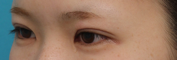 症例写真,全切開法にて二重の幅を自然に広げた症例写真,After(4ヶ月後),ba_sekkai066_b03.jpg