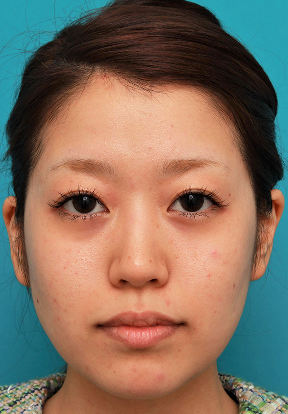 症例写真,メソシェイプフェイス(顔専用の脂肪溶解注射)で小顔になった20代女性の症例写真,Before,ba_meso_face014_b01.jpg