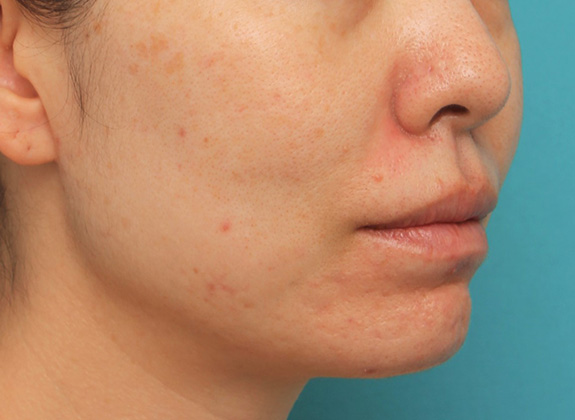 唇を薄く(口唇縮小術),分厚い上下の唇を手術で薄くした症例写真,After(6ヶ月後),ba_usuku012_b03.jpg