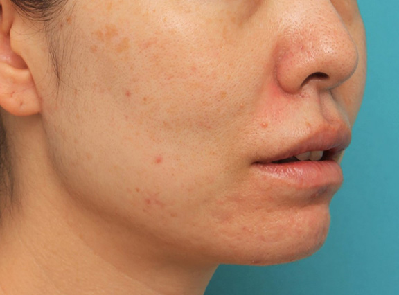 唇を薄く(口唇縮小術),分厚い上下の唇を手術で薄くした症例写真,After(6ヶ月後),ba_usuku012_b04.jpg