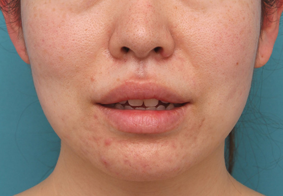 唇を薄く(口唇縮小術),分厚い上下の唇を手術で薄くした症例写真,Before,ba_usuku012_b02.jpg
