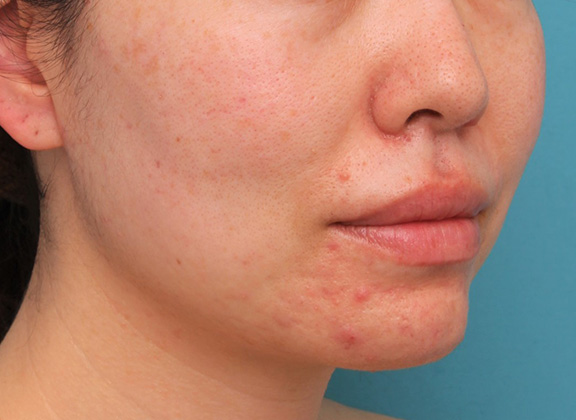 唇を薄く(口唇縮小術),分厚い上下の唇を手術で薄くした症例写真,Before,ba_usuku012_b03.jpg