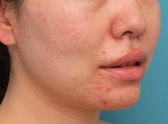 唇を薄く(口唇縮小術),分厚い上下の唇を手術で薄くした症例写真,Before,ba_usuku012_b04.jpg
