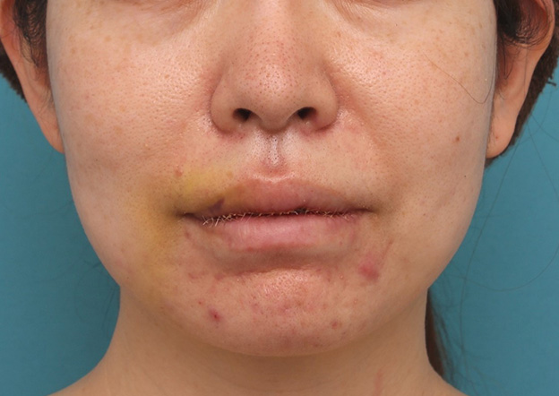 唇を薄く（口唇縮小術）,分厚い上下の唇を手術で薄くした症例写真,5日後,口を閉じた状態,mainpic_usuku012e.jpg