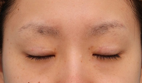 眼瞼下垂(がんけんかすい),患者様の希望で幅広平行型二重を眼瞼下垂手術で作り、同時に目頭切開と目尻切開を行った症例写真,After(6ヶ月後の目を閉じた状態),