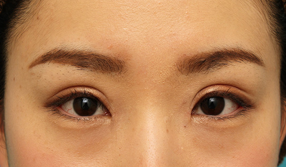 眼瞼下垂(がんけんかすい),患者様の希望で幅広平行型二重を眼瞼下垂手術で作り、同時に目頭切開と目尻切開を行った症例写真,After(6ヶ月後のメイクあり),