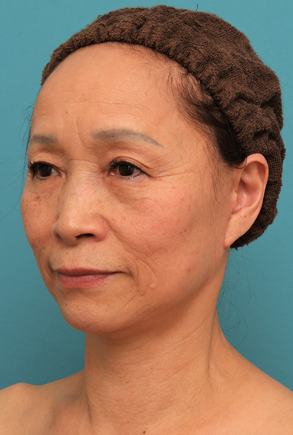 フルフェイスリフト,フェイスリフトで頬、フェイスライン、首のたるみをリフトアップさせた70代女性の症例写真,After(6ヶ月後),ba_facelift005_b02.jpg