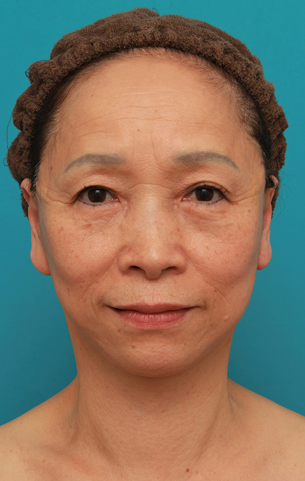 フルフェイスリフト,フェイスリフトで頬、フェイスライン、首のたるみをリフトアップさせた70代女性の症例写真,1週間後,mainpic_facelift005d.jpg