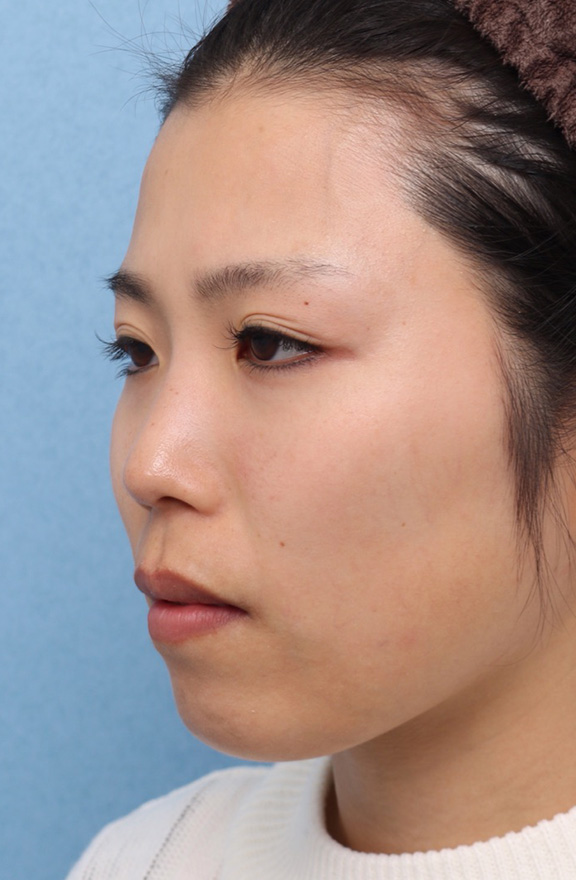 隆鼻注射(ヒアルロン酸注射),隆鼻ヒアルロン酸の症例写真,Before,ba_ryubi2037_b02.jpg