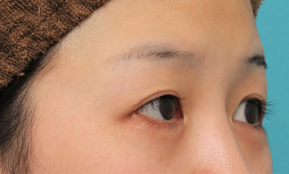 症例写真,目尻切開で目を外側に広げた20代女性の症例写真,After(6ヶ月後),ba_mejiri022_b02.jpg