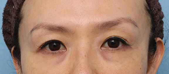 症例写真,サーマクールアイFLXの症例 まぶたのタルミが気になり始めた40代女性,After(1ヶ月後),ba_thermacool_eye009_b01.jpg