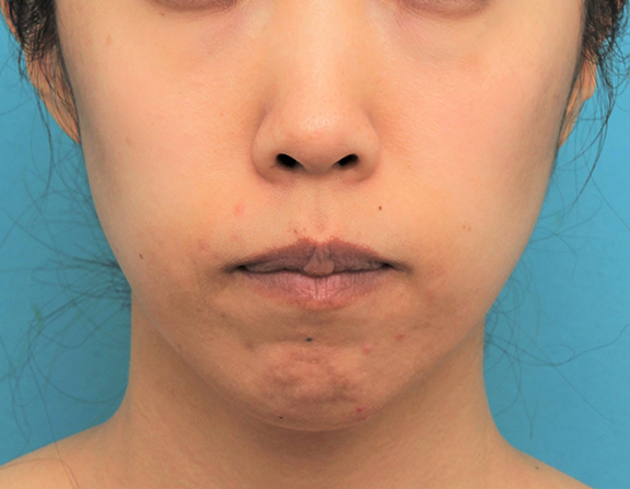 症例写真,ガミースマイルを手術で治した40代女性の症例写真,After(6ヶ月後),ba_gammy006_b02.jpg