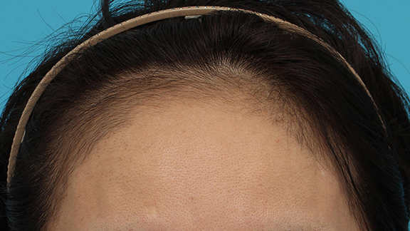 症例写真,女性の薄毛治療(内服薬(ミノキシジル)、PRP育毛治療(第三種再生医療))の症例写真,After(1ヶ月後),ba_aga_josei004_b01.jpg