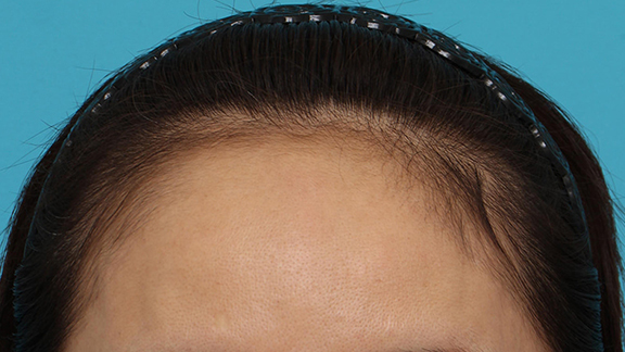 症例写真,女性の薄毛治療(内服薬(ミノキシジル)、PRP育毛治療(第三種再生医療))の症例写真,Before,ba_aga_josei004_b01.jpg