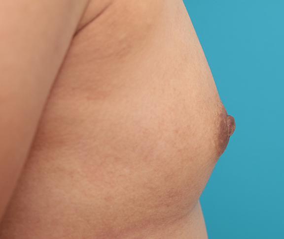 症例写真,30代後半女性の乳頭縮小手術症例写真,After(6ヶ月後),ba_nyuto021_b03.jpg