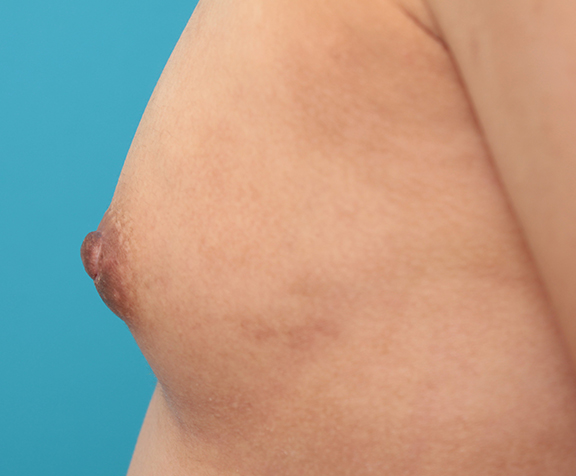 症例写真,30代後半女性の乳頭縮小手術症例写真,After(6ヶ月後),ba_nyuto021_b05.jpg