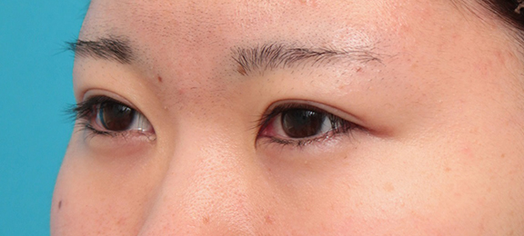 症例写真,二重まぶた・埋没法の症例 幅の狭い平行二重にしたいと希望の20代女性,After(1ヶ月後),ba_maibotsu055_b02.jpg