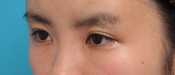 症例写真,二重まぶた・埋没法の症例 末広型でナチュラルなラインを希望の女性,After(6週間後),ba_maibotsu056_b02.jpg