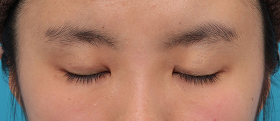 症例写真,二重まぶた・埋没法の症例 末広型でナチュラルなラインを希望の女性,After(6週間後),ba_maibotsu056_b03.jpg