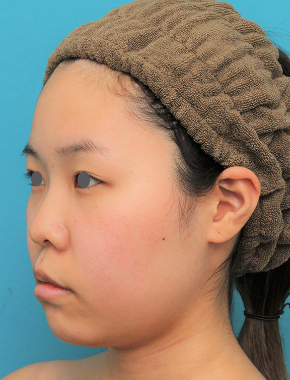 症例写真,顔(頬~フェイスライン~顎下)の脂肪吸引をした20代女性の症例写真,Before,ba_shibo006_b02.jpg