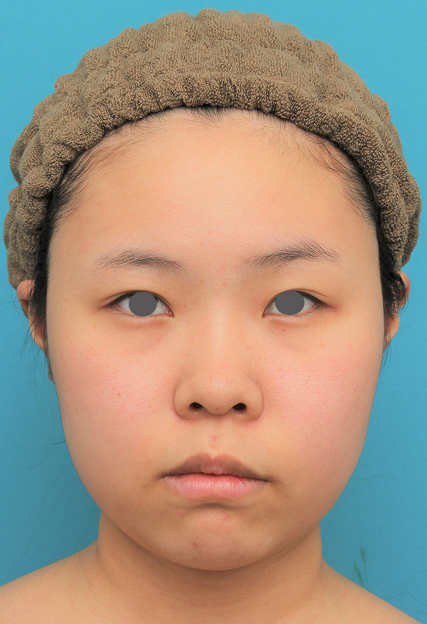 症例写真,顔(頬~フェイスライン~顎下)の脂肪吸引をした20代女性の症例写真,手術前,mainpic_shibo006a.jpg