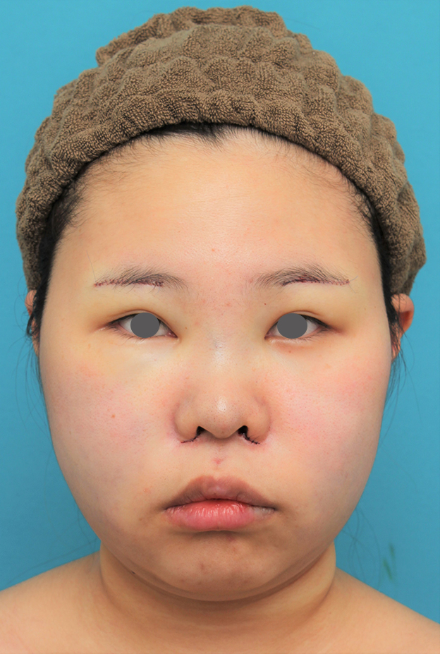 症例写真,顔(頬~フェイスライン~顎下)の脂肪吸引をした20代女性の症例写真,手術直後,mainpic_shibo006b.jpg