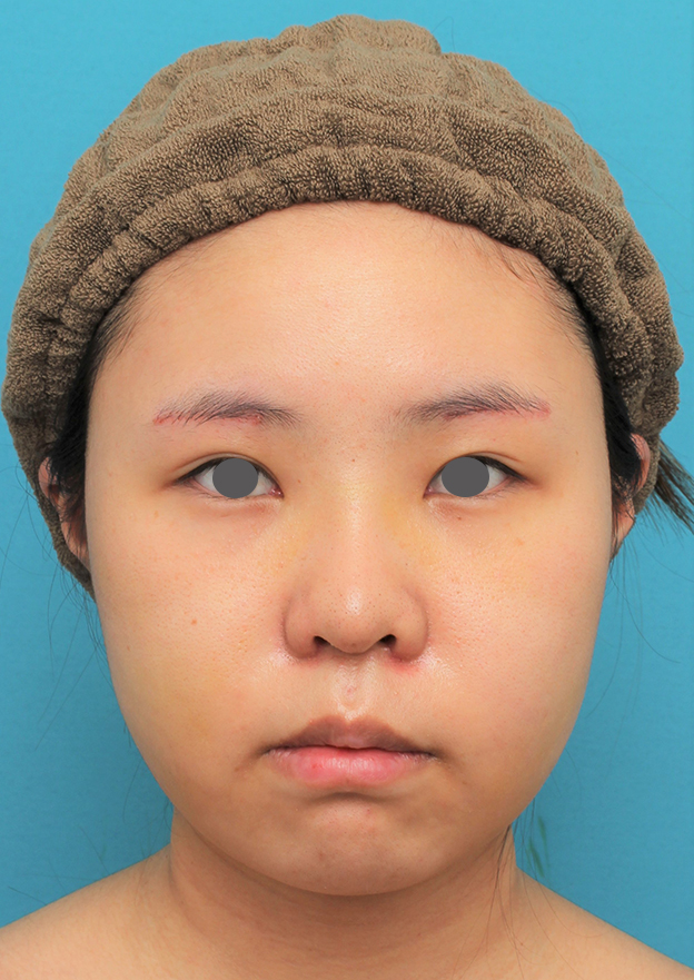 症例写真,顔(頬~フェイスライン~顎下)の脂肪吸引をした20代女性の症例写真,6日後,mainpic_shibo006c.jpg