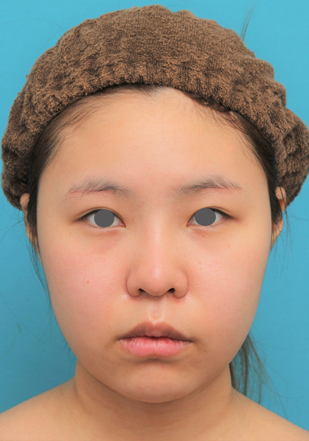 症例写真,顔(頬~フェイスライン~顎下)の脂肪吸引をした20代女性の症例写真,3週間後,mainpic_shibo006d.jpg