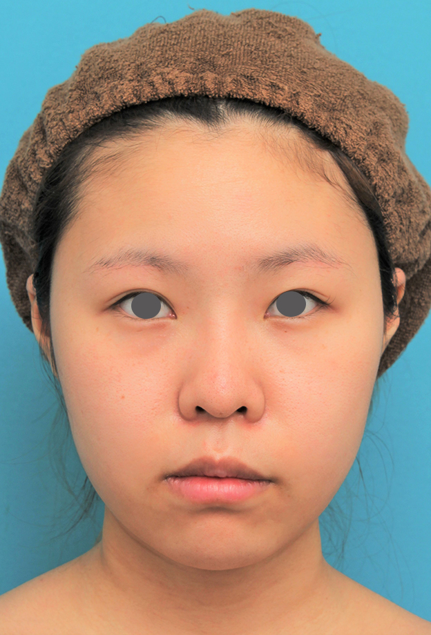 症例写真,顔(頬~フェイスライン~顎下)の脂肪吸引をした20代女性の症例写真,2ヶ月後,mainpic_shibo006e.jpg