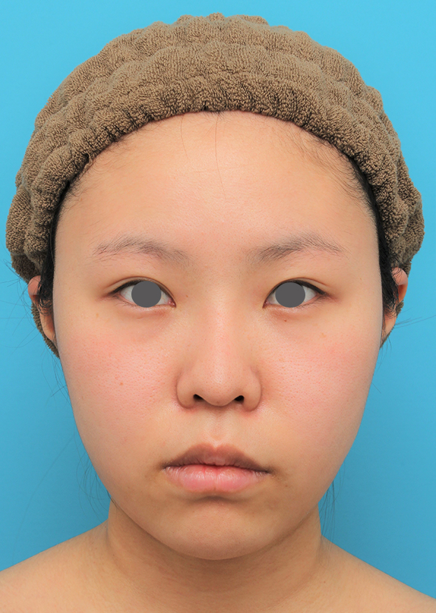 症例写真,顔(頬~フェイスライン~顎下)の脂肪吸引をした20代女性の症例写真,6ヶ月後,mainpic_shibo006f.jpg