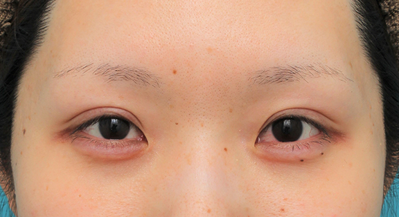 症例写真,涙袋ヒアルロン酸注射を行った20代女性の症例写真,After(1ヶ月後),ba_namida016_b01.jpg