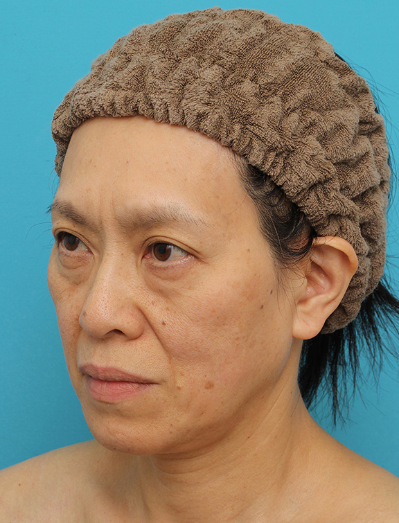 Vシェイプリフト(ヒアルロン酸注射),Vシェイプリフト(ヒアルロン酸注射)の症例 目の下のタルミが強い60代女性,Before,ba_v_shapelift022_b03.jpg