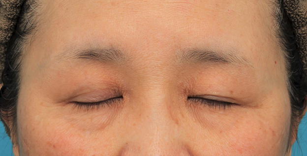 症例写真,片目の眼瞼下垂手術を行い、左右差を治した60代女性の症例写真,手術前,mainpic_ganken042b.jpg