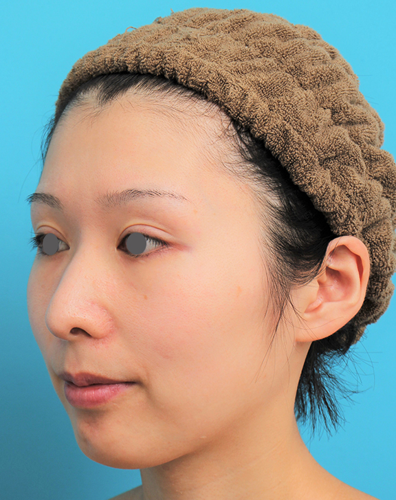 あご形成(シリコンプロテーゼ),顎にシリコンプロテーゼを入れた20代女性の症例写真,After(6ヶ月後),ba_ago022_b02.jpg