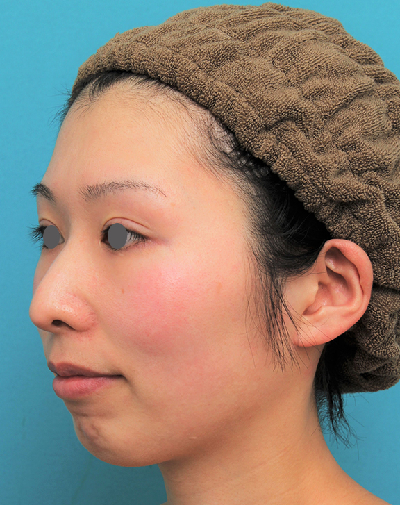 あご形成(シリコンプロテーゼ),顎にシリコンプロテーゼを入れた20代女性の症例写真,Before,ba_ago022_b02.jpg
