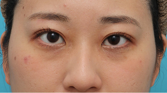二重まぶた・埋没法,二重まぶた・埋没法の症例 腫れぼったい一重まぶたの方も目頭切開が不要,After(メイクあり)<br/>
(1ヶ月後),