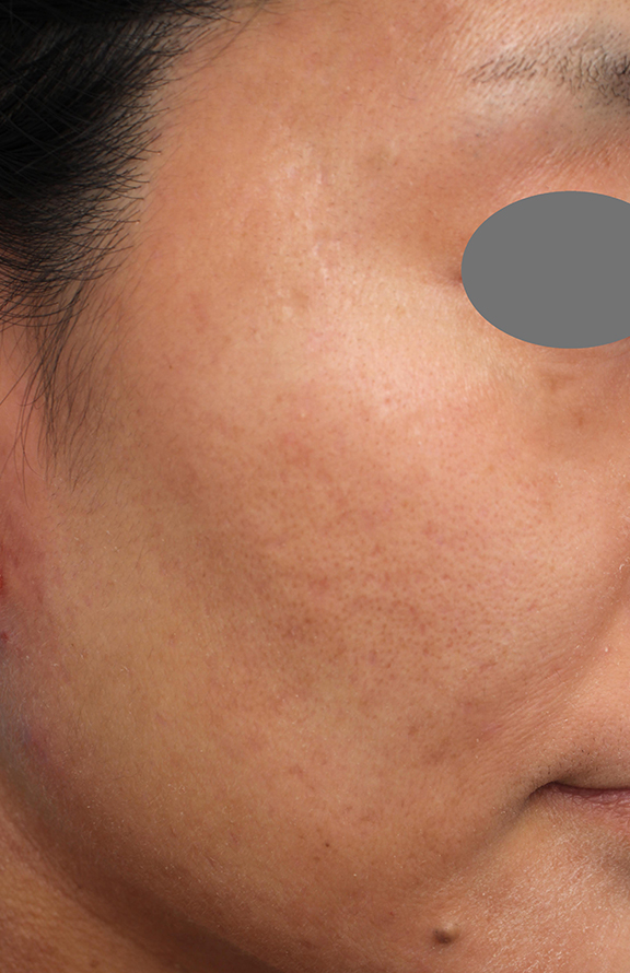 症例写真,ヴァンパイアフェイシャルの症例写真,After(6回目治療1ヶ月後),ba_vampirefacial001_b01.jpg