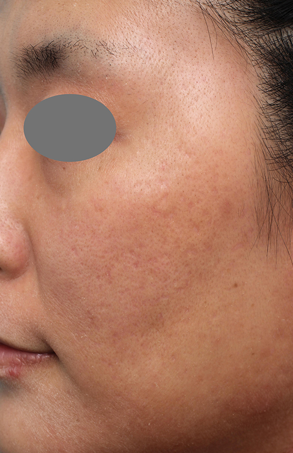 症例写真,ヴァンパイアフェイシャルの症例写真,After(6回目治療1ヶ月後),ba_vampirefacial001_b03.jpg